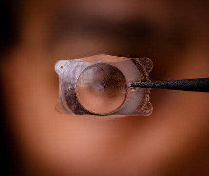 photo of Implantable Collamer Lens ICL for treating refractive errors, infront of a human eye