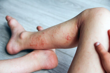 atopic dermatitis on the legs of a child