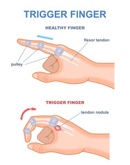 Trigger finger diagram. Joints stuck in bent position. Anatomy of tendons and bones of hand index finger. Medical trauma flexor tendon from inside educational scheme. Cartoon flat vector illustration