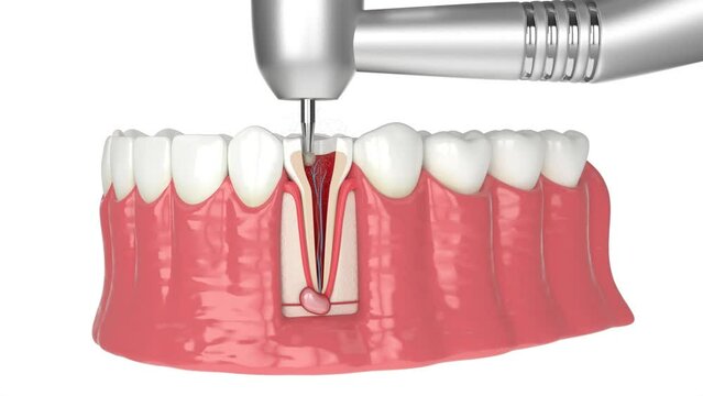 Lower jaw with dental root canal treatment procedure