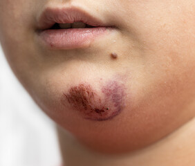 hematoma on the skin of the face as a background.