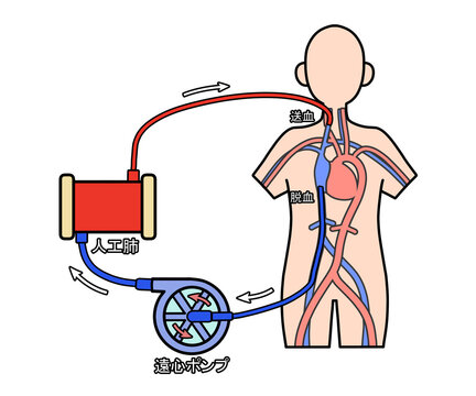 VV-ECMO