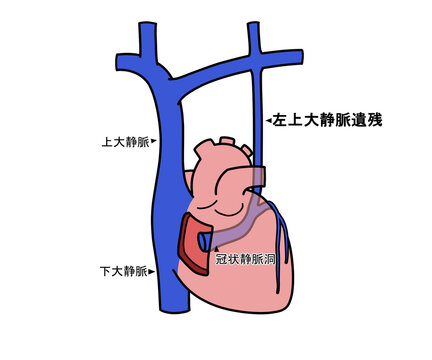 左上大静脈遺残（PLSVC）