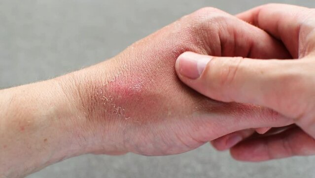 Peeling of Skin after Sun or thermal Burn