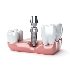 Dental implantation, teeth with implant screw, 3d illustration