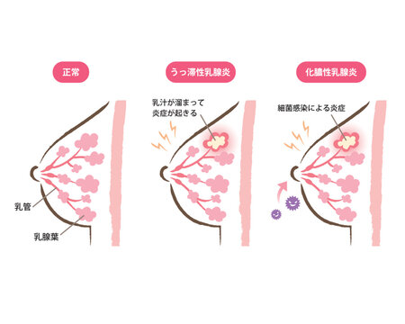 乳腺炎のバストの断面図のイラスト