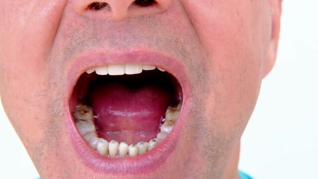 dental prosthetist examines oral cavity patient, charismatic mature man 60 years old open mouth, shows teeth with temporary fillings and metal, titanium pins for prosthetics or splinting, prosthetics