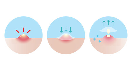 Direction for use acne pimple patch for inflammatory acne vector icon set illustration on white background. How to use, step for use acne patch absorbing pustule on skin face. Skin care concept.