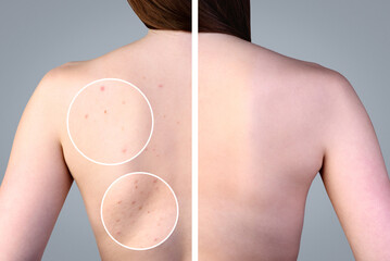 Before and after treatment acne pimples on skin back of teenager.