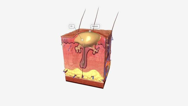 Closed comedones (whiteheads) are a type of acne characterized by small pink bumps with white, pus-filled centers.