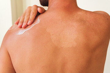 Unrecognizable man applying after sun cream on his back with sunburn. sun protection concept.
