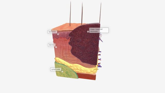 Basal Cell Carcinoma in Tissue, Stage II