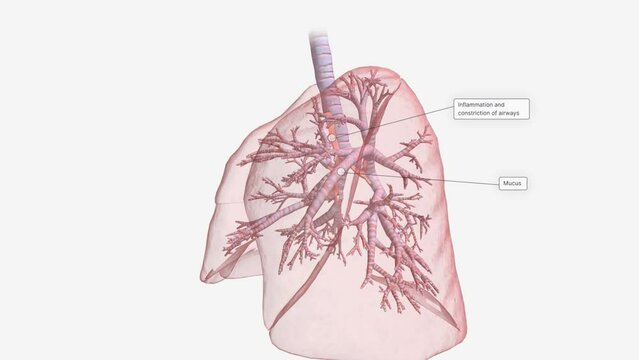Inflammation and constriction of airways
