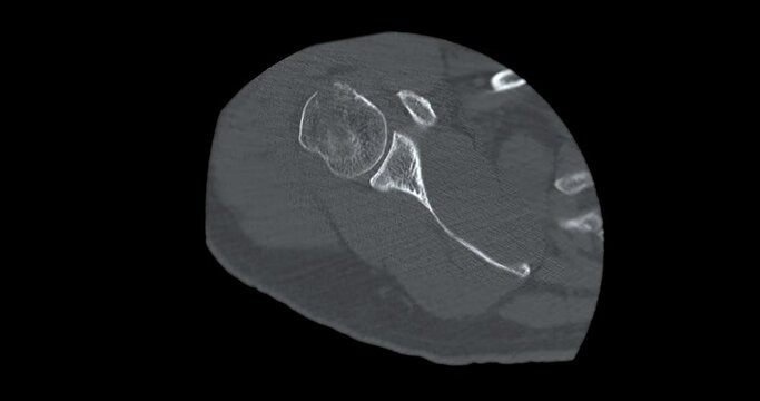 CT scan of  shoulder joint axial view showing fracture head of humerus .