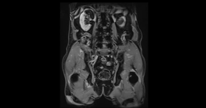 MRI Whole Abdomen Coronal T2 view