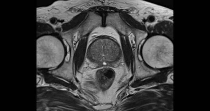 MRI prostate gland Axial T2W in aged mens for diagnosis prostate cancer cell .