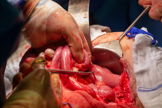 Surgical operation, closeup on operating field and hands of surgeons
