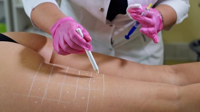 Beautician injections syr slimming liposuction procedure on client's hips in beautician clinic. Self care, skin care, beauty treatment