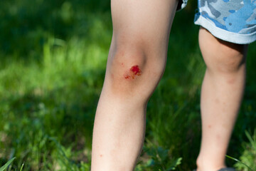 Closeup of fresh bleeding wound on child knee due to fall. Childhood trauma, pain, carelessness, accident. Childrens injuries in summer outdoors