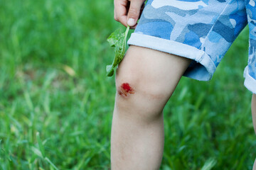 Closeup of fresh bleeding wound on child knee due to fall. Childhood trauma, pain, carelessness,...