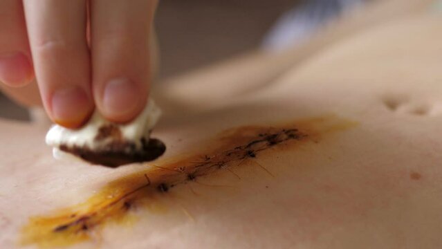Abdomen of young girl. Closeup video of the long scar above navel after abdominal surgery for umbilical and inguinal hernias. Woman is treating the scar with betadine. Postpartum recovery.