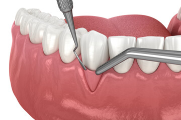 Gingiva Recession: Soft tissue graft surgery. 3D illustration of Dental  treatment