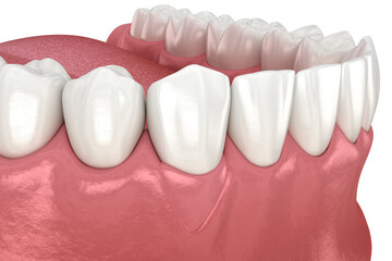 Gingiva Recession: Soft tissue graft surgery. 3D illustration of Dental  treatment - 609621518