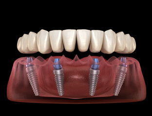 Dental prosthesis based on 4 implants. Dental 3D illustration - 609621542