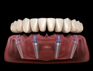 Deurstickers Dental prosthesis based on 4 implants. Dental 3D illustration © Alex Mit