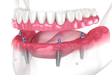 Dental prosthesis based on 4 implants. Dental 3D illustration - 609621574