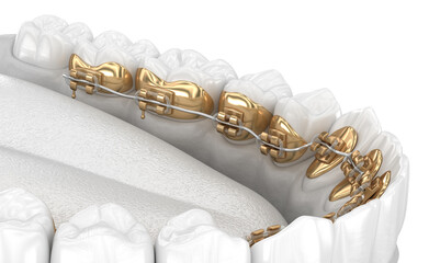 Lingual braces system. 3D illustration concept of golden braces - obrazy, fototapety, plakaty