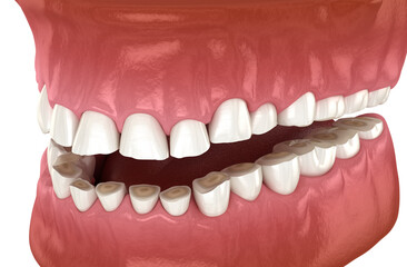 Dental attrition (Bruxism) resulting in loss of tooth tissue. Dental 3D illustration
