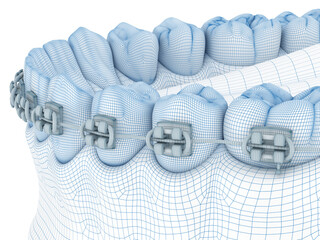 Braces and denture. Wire 3d model illustration
