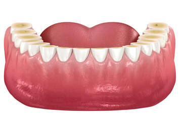 Dental attrition (Bruxism) resulting in loss of tooth tissue. Dental 3D illustration