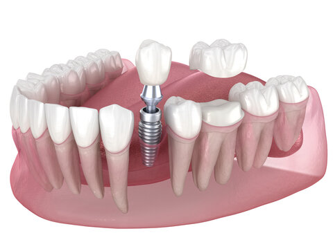 Dental implant and ceramic crown. Medically accurate tooth 3D illustration.