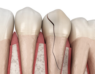 Cracked tooth, splitted. Dental 3D illustration - 609621955