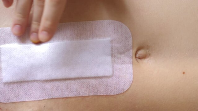 Abdomen of young girl. Closeup video of girl's hand is changing bandage after the abdominal surgery for umbilical and inguinal hernias. Irritation from the patch. Postoperative recover.