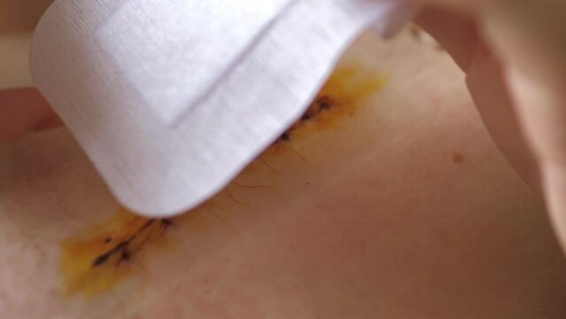 Abdomen of young girl. Closeup video of girl's hand is changing bandage after the abdominal surgery for umbilical and inguinal hernias. Irritation from the patch. Postoperative recover.