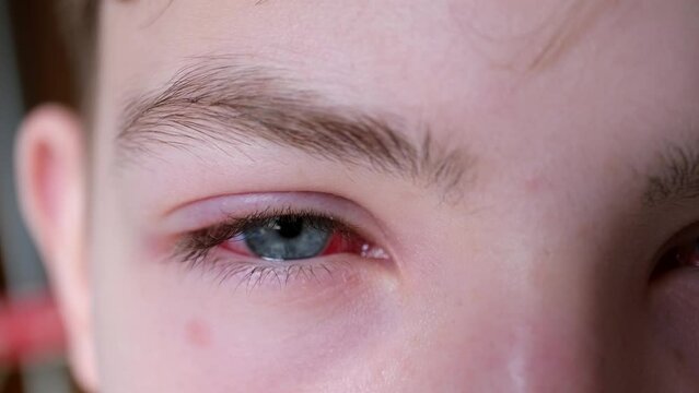 Irritated red blood eye looks straight ahead. Conjunctivitis after flu, cold or allergy close-up