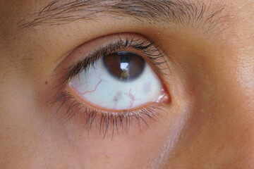 Fototapeta premium Grey spots in the white part of the eye of a girl, Ocular Melanosis