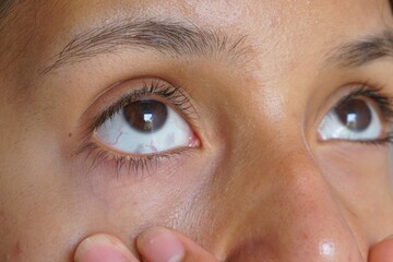 Grey spots in the white part of the eye of a girl, Ocular Melanosis