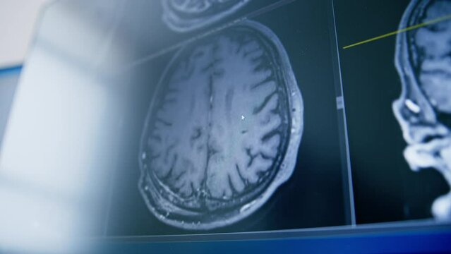 computer tomography brain 3d rendering image on screen brain inflammation disease in clinic