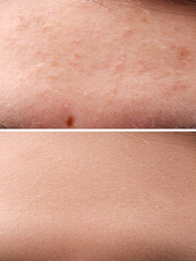 Fototapeta premium Collage with photos of woman with acne problem before and after treatment, closeup