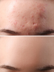 Fototapeta premium Collage with photos of woman with acne problem before and after treatment, closeup