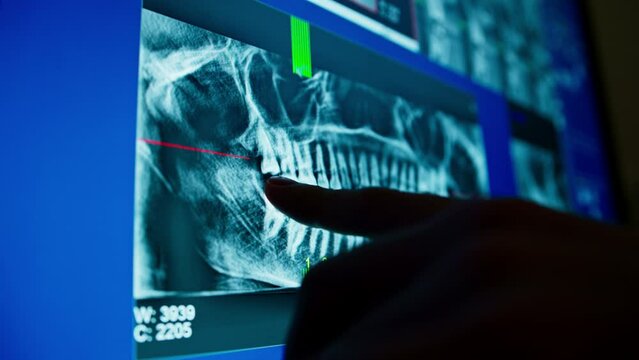 dental scan on x-ray image of patient's jaw on computer screen zooming dental row of dental clinic doctor shows diseased teeth