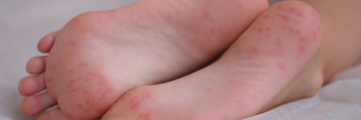 Eczema is an irritation caused by an allergic lesion of skin of feet in child. Infectious skin...