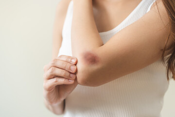 Close up of stain bruise wound on arm, contusion asian young woman, girl an accident fell down...