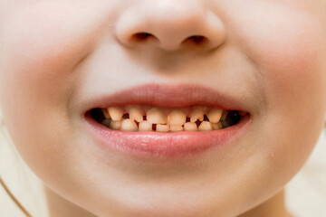 Close up view on of child milk teeth