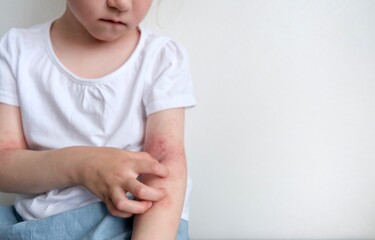 The child scratches atopic skin. Dermatitis, diathesis, allergy on the child's body.	
