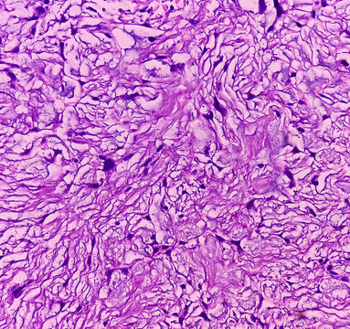 Salivary mucoid cyst. microscopic show parotid tissue, features of cyst wall composed of myxoid material and histiocytes. Histology. Parotid cancer.